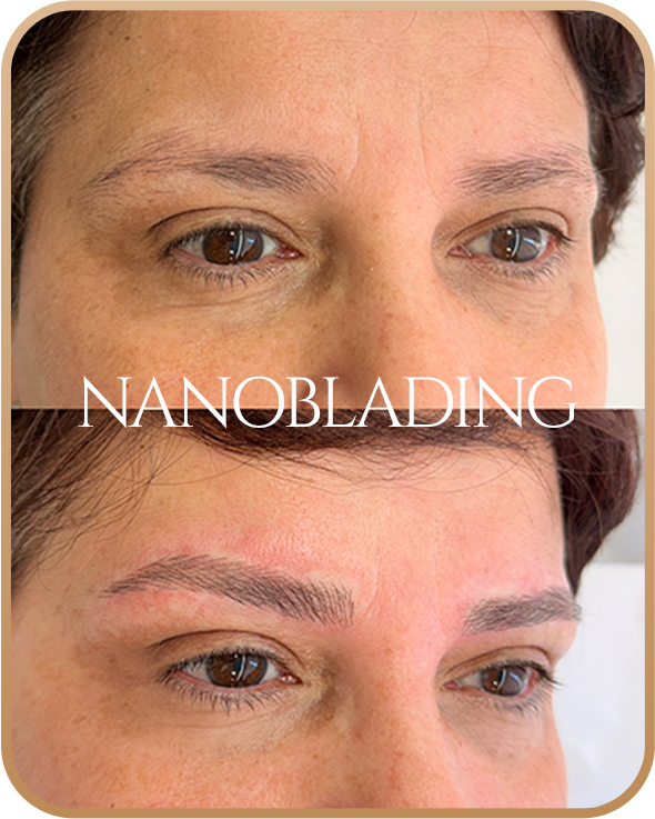 NANOBLADING